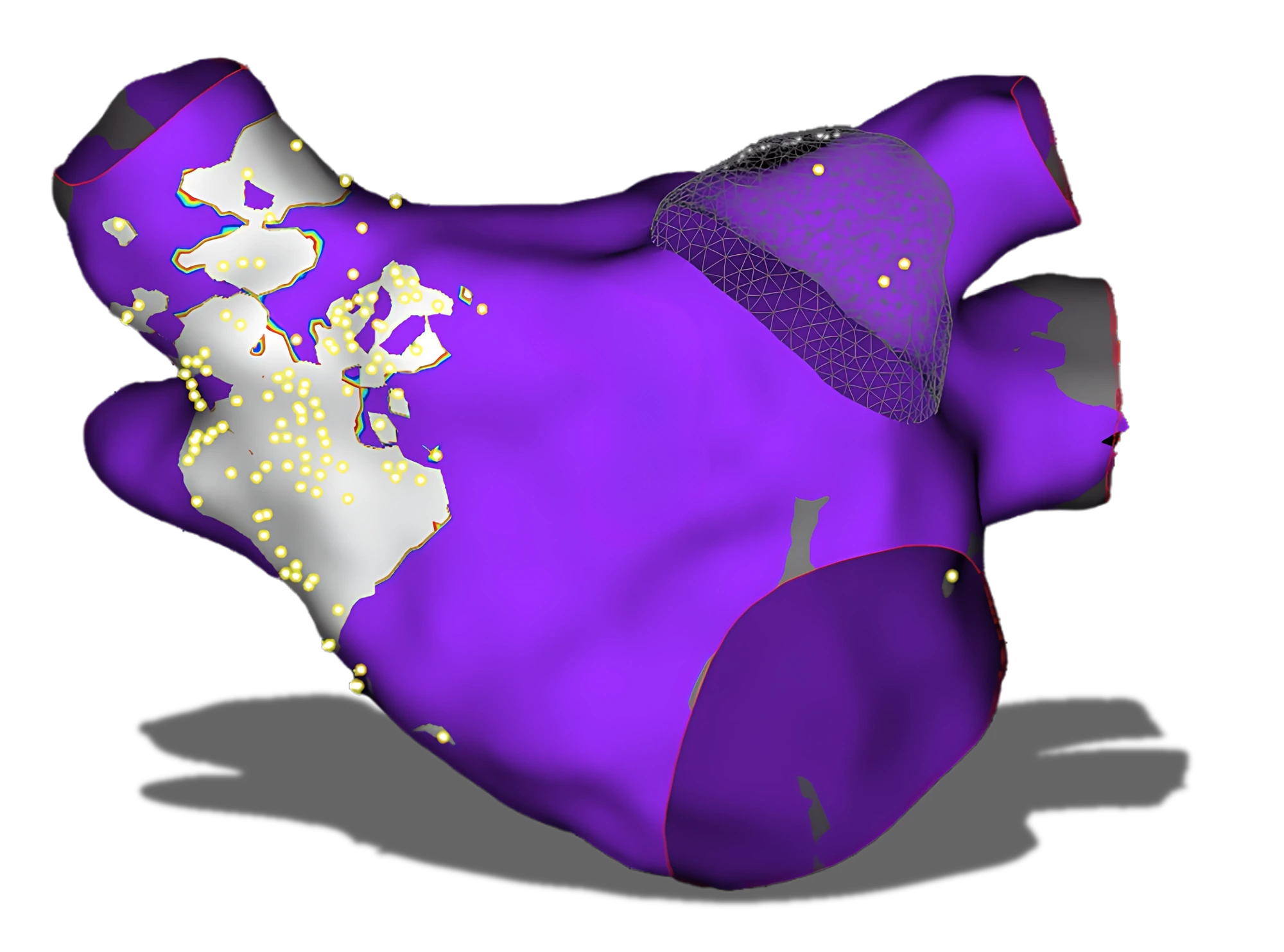 Three-dimensional electroanatomical map with highlighted regions and mapping points.