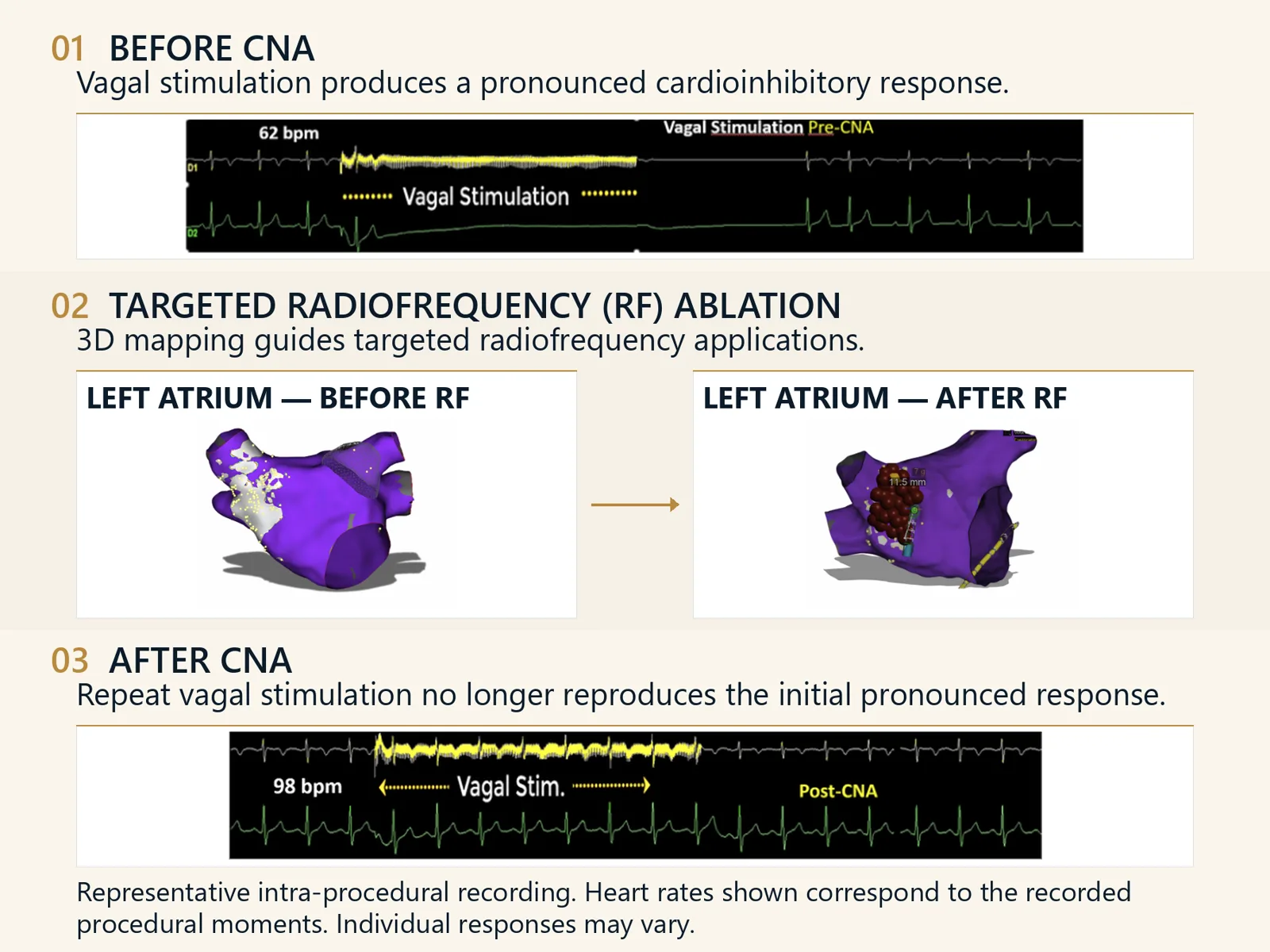 Clinical record in three steps: a pre-CNA tracing showing a pronounced cardioinhibitory response to vagal stimulation (62 bpm); left atrium 3D maps before and after targeted radiofrequency ablation; and a post-CNA tracing showing the response no longer reproduced (98 bpm).